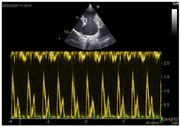 Pulsed wave doppler image courtesy of Emily Dutton at Cheshire Cardiology 1